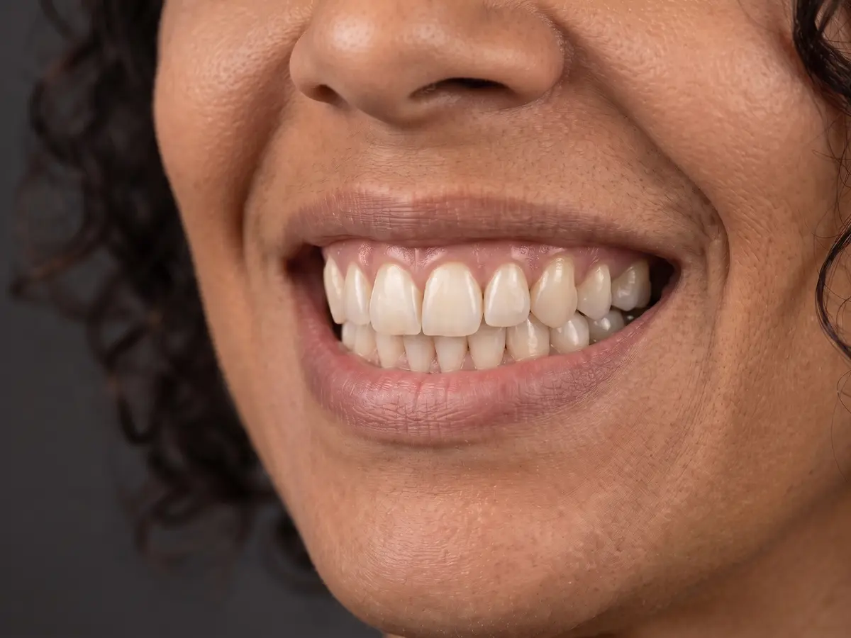 Caso 04 — Clareamento dentário, depois do tratamento